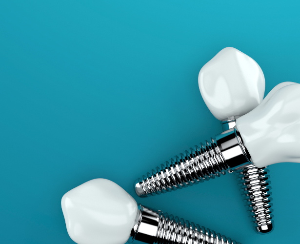 Dental Implant Cost in Ottawa
