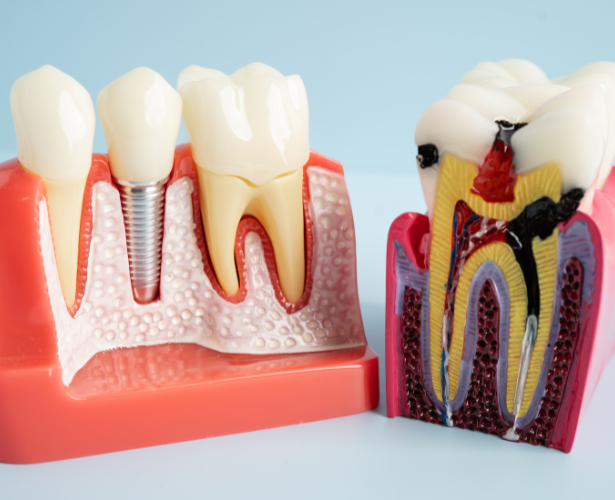 Illustration of tooth roots and nerves for root canal treatment
