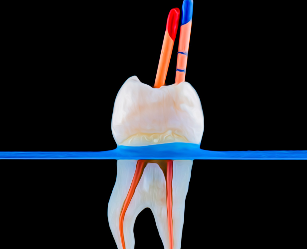 Tooth models showing dental implant and infected tooth needing root canal